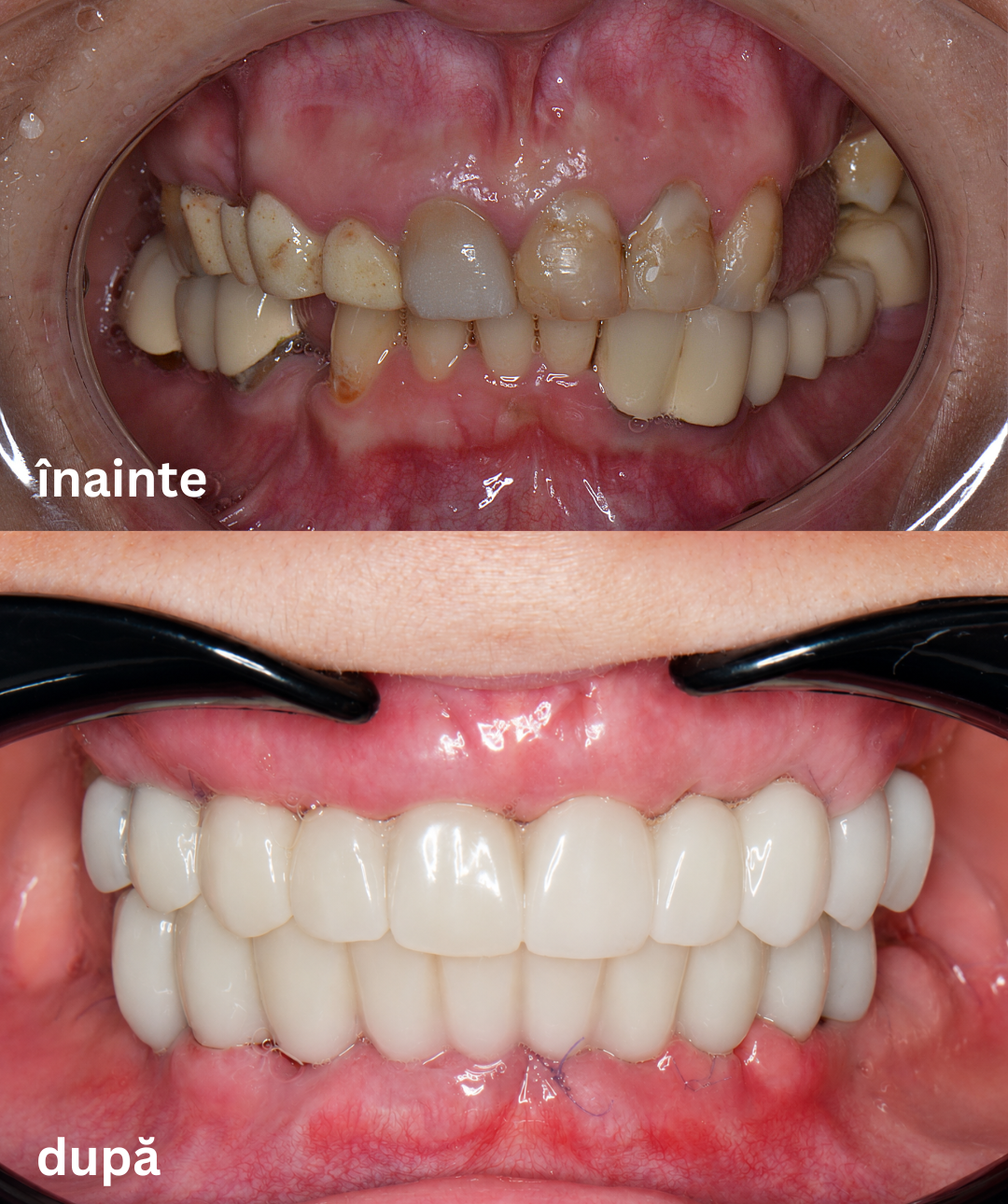 înainte
